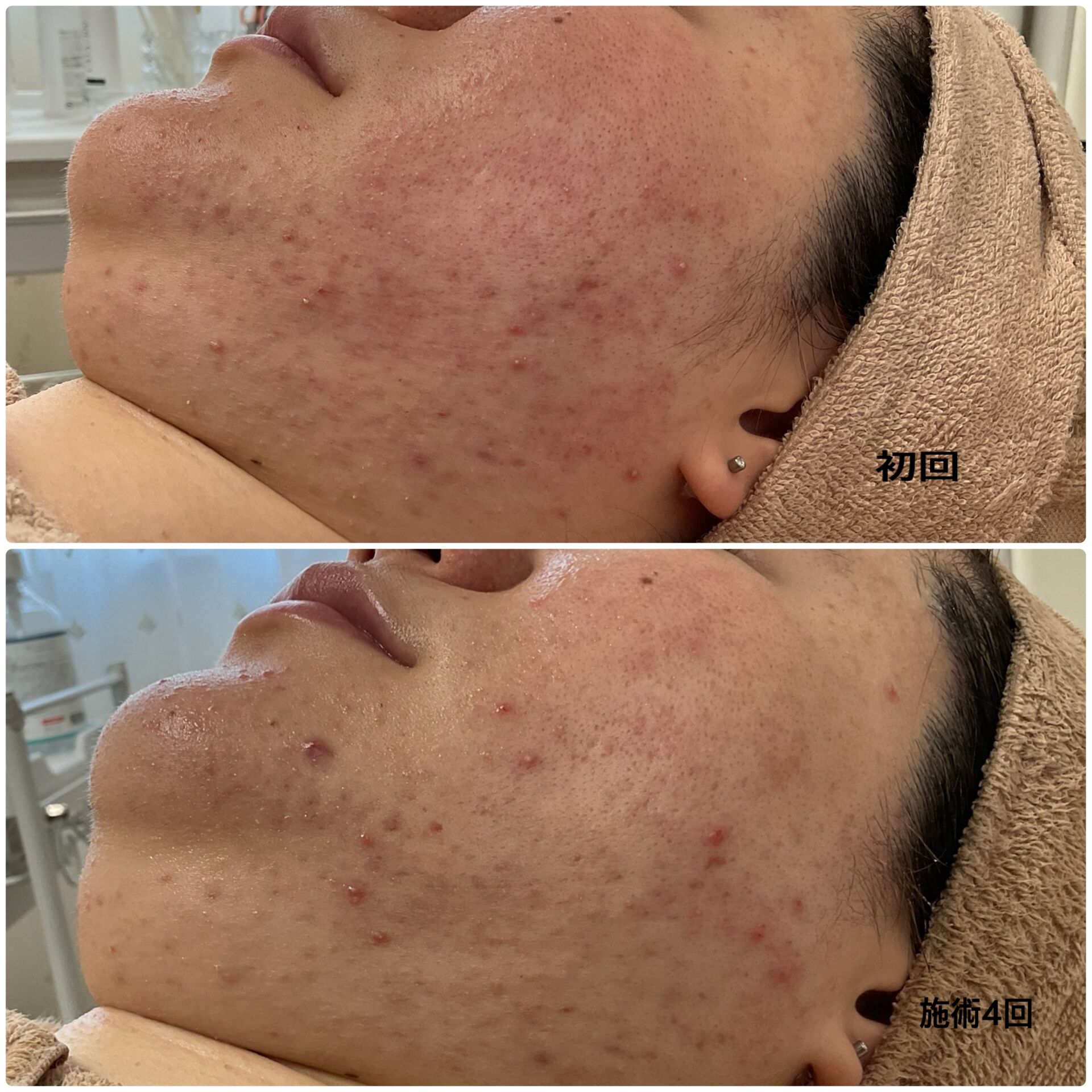 石川県金沢市 ニキビケアなら ニキビケア専門フェイシャルエステ リセット アイ
